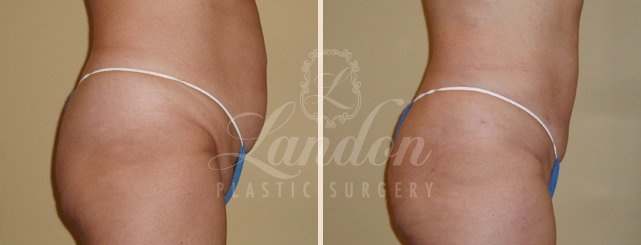 Liposuction Before & After Image