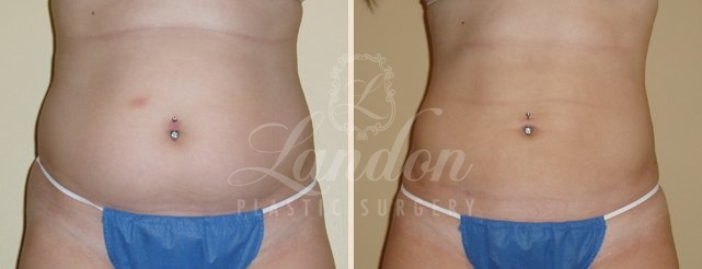 Liposuction Before & After Image