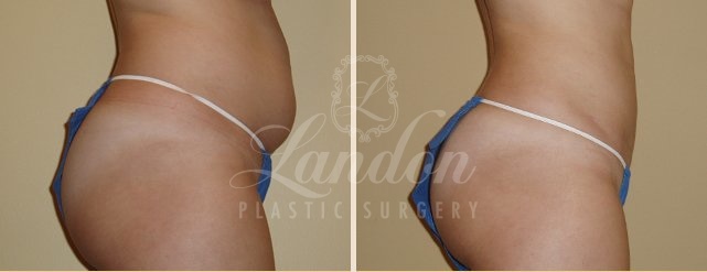 Liposuction Before & After Image