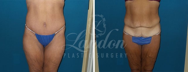 Trunk Lift Before & After Image