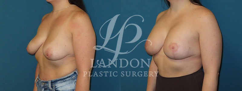 Breast Augmentation Before & After Image