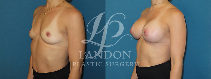 Breast Augmentation Before & After Image