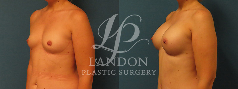Breast Augmentation Before & After Image