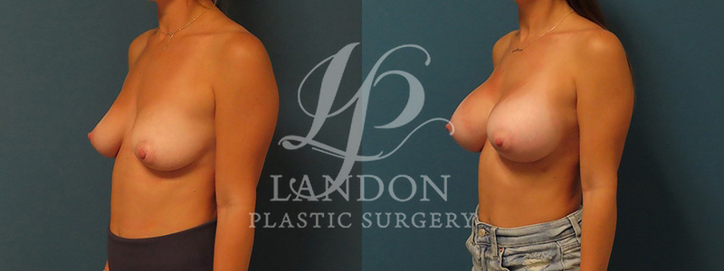 Breast Augmentation Before & After Image