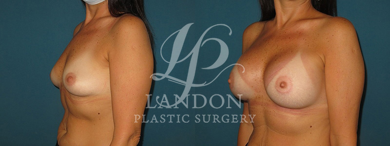 Breast Augmentation Before & After Image