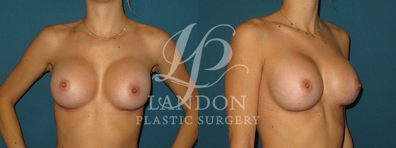 Breast Augmentation Before & After Image