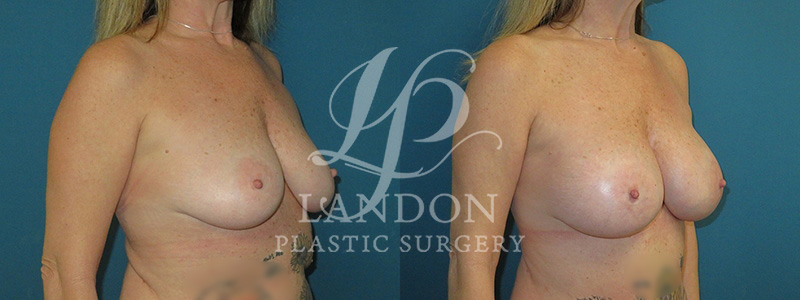 Breast Augmentation Before & After Image