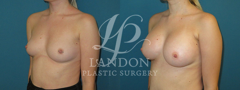 Breast Augmentation Before & After Image