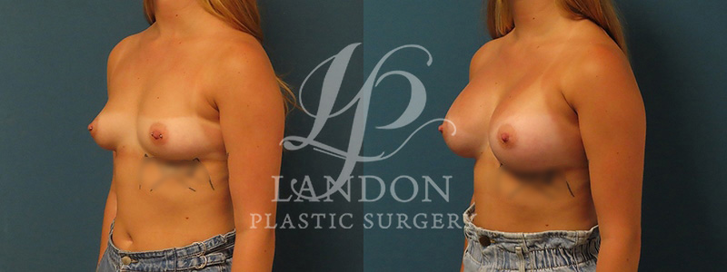 Breast Augmentation Before & After Image