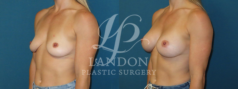 Breast Augmentation Before & After Image