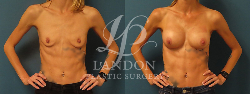 Breast Augmentation Before & After Image