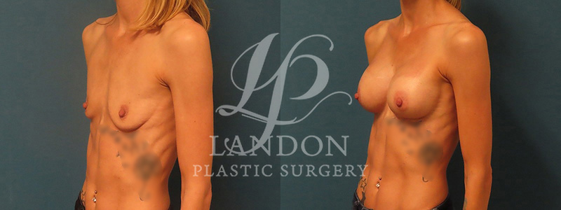 Breast Augmentation Before & After Image