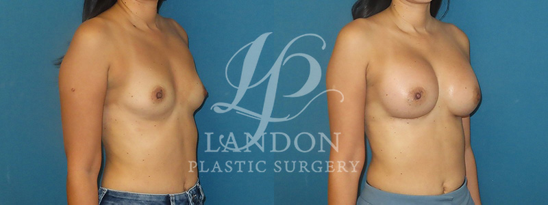 Breast Augmentation Before & After Image