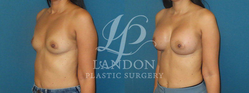 Breast Augmentation Before & After Image
