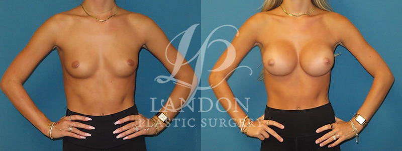 Breast Augmentation Before & After Image