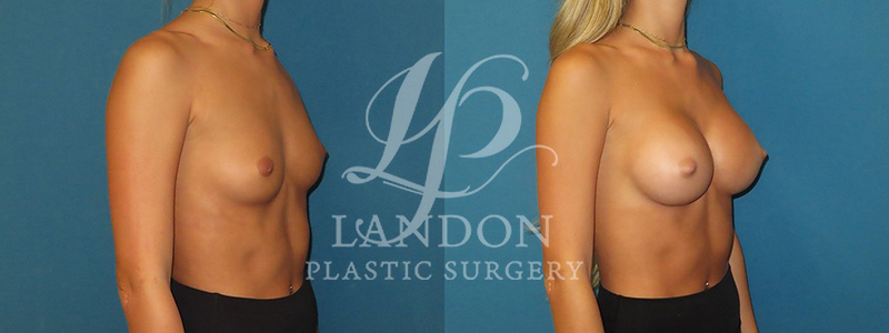 Breast Augmentation Before & After Image