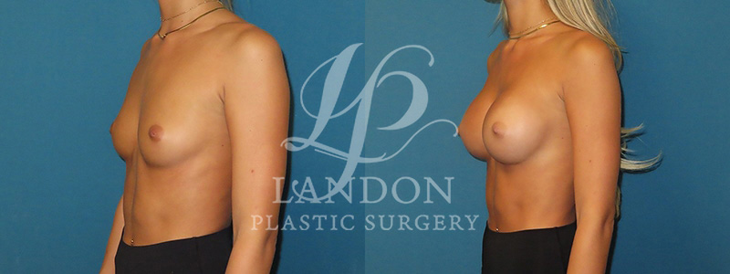 Breast Augmentation Before & After Image