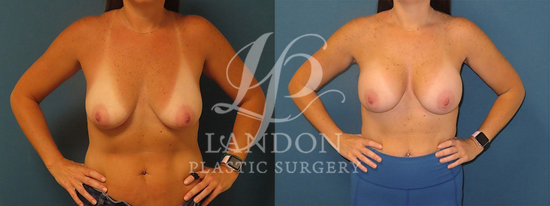 Breast Augmentation Before & After Image