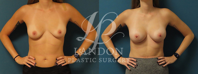 Breast Augmentation Before & After Image