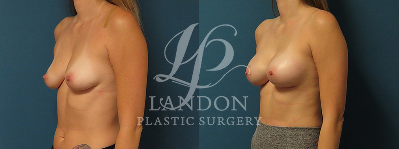 Breast Augmentation Before & After Image
