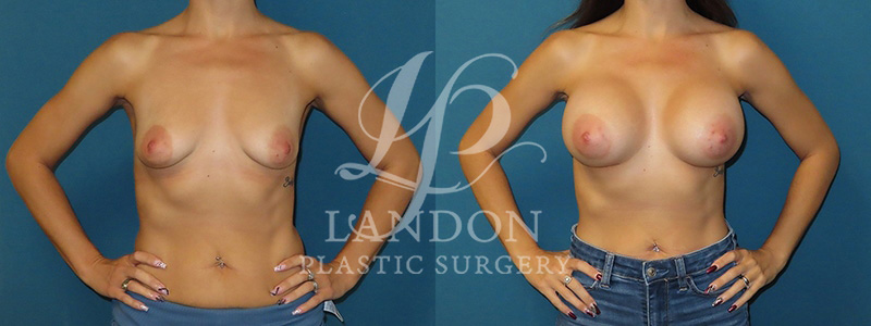 Breast Augmentation Before & After Image