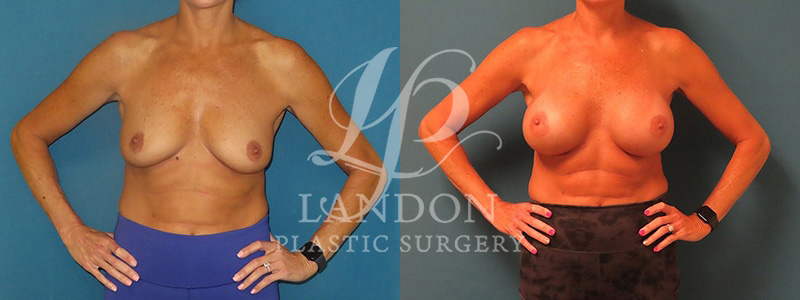 Breast Augmentation Before & After Image