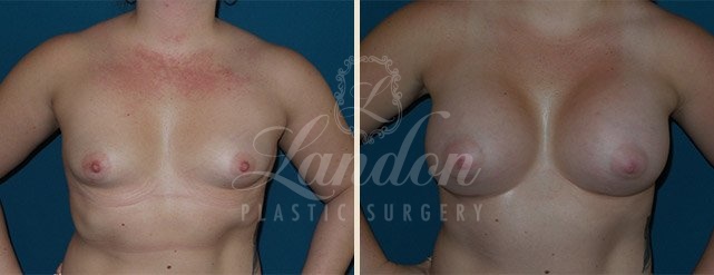 Breast Augmentation Before & After Image