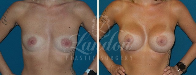 Breast Augmentation Before & After Image