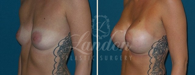 Breast Augmentation Before & After Image