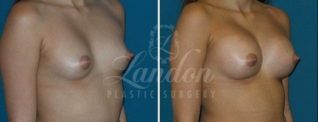 Breast Augmentation Before & After Image