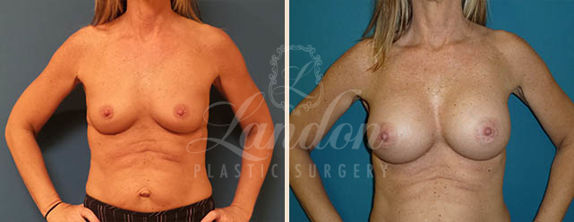 Breast Augmentation Before & After Image