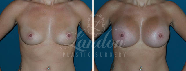 Breast Augmentation Before & After Image