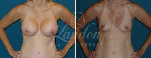 Breast Augmentation Before & After Image