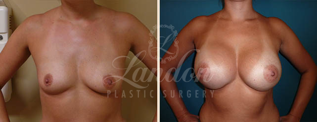 Breast Augmentation Before & After Image