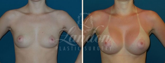 Breast Augmentation Before & After Image