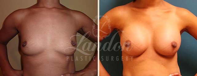 Breast Augmentation Before & After Image