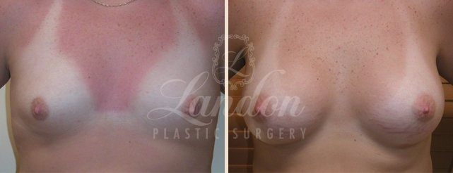 Breast Augmentation Before & After Image
