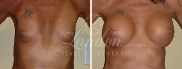 Breast Augmentation Before & After Image