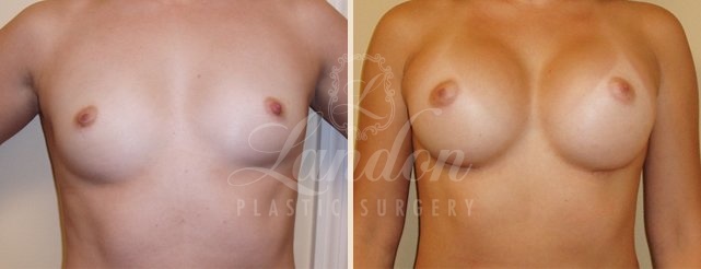 Breast Augmentation Before & After Image
