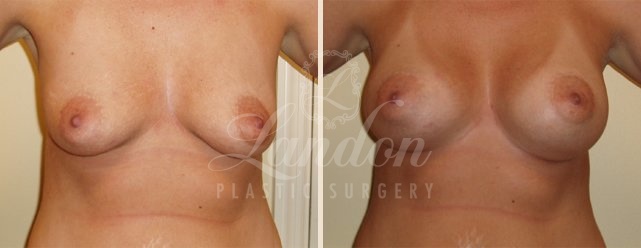 Breast Augmentation Before & After Image