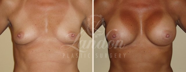 Breast Augmentation Before & After Image