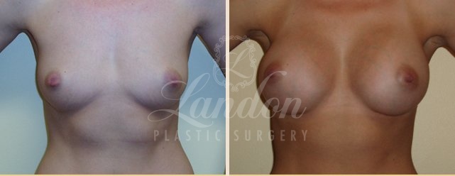 Breast Augmentation Before & After Image