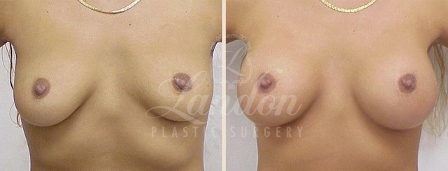 Breast Augmentation Before & After Image
