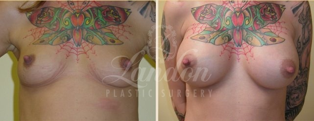 Breast Augmentation Before & After Image