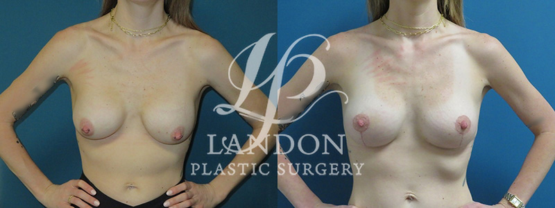 Breast Implant Exchange Before & After Image