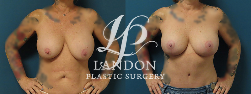Breast Implant Exchange Before & After Image