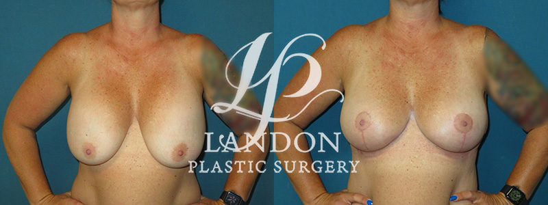 Breast Implant Exchange Before & After Image