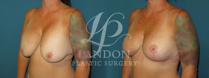 Breast Implant Exchange Before & After Image