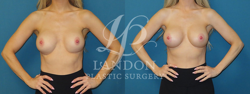 Breast Implant Exchange Before & After Image