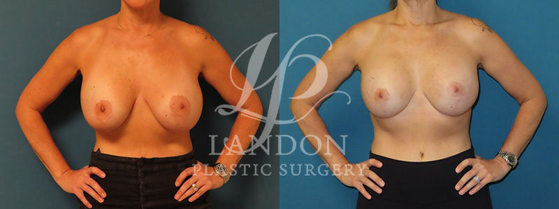 Breast Implant Exchange Before & After Image